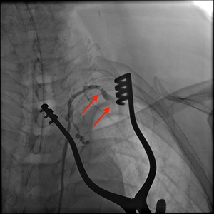 Patent anastomosis